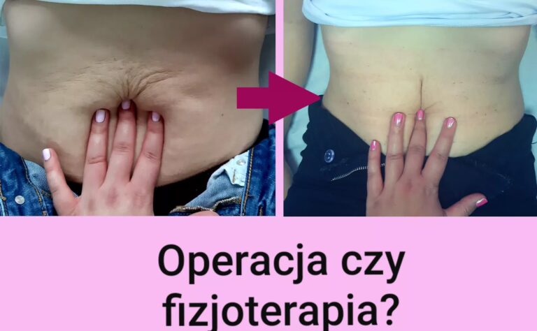 ?FIZJOTERAPIA ZAMIAST OPERACJI W ROZEJŚCIU MIĘŚNI PROSTYCH BRZUCHA?